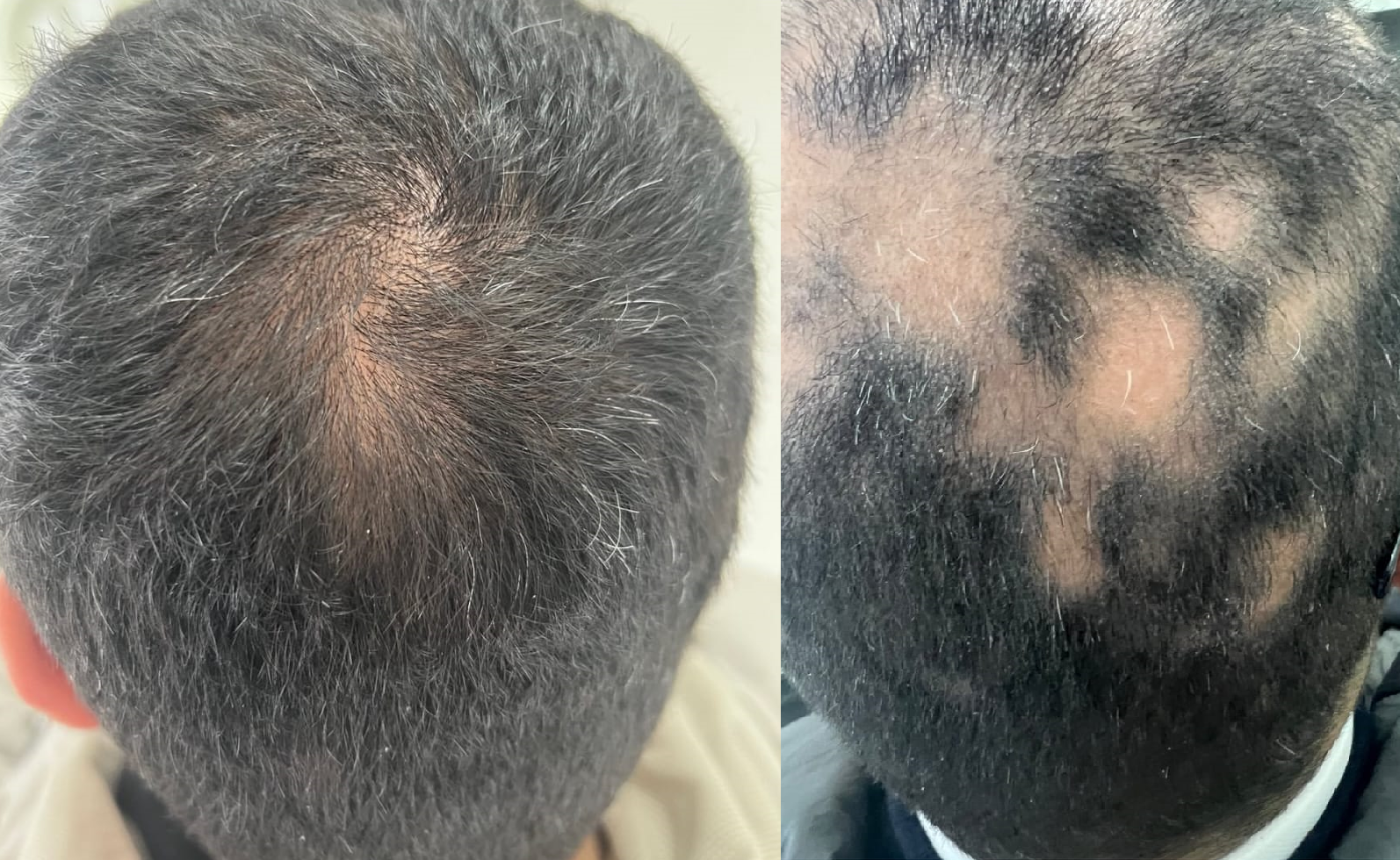 ALOPESİ AREATA ( ŞAÇKIRAN  )